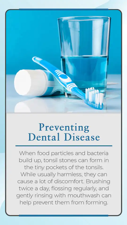 Dental Tips  Tonsil Stones