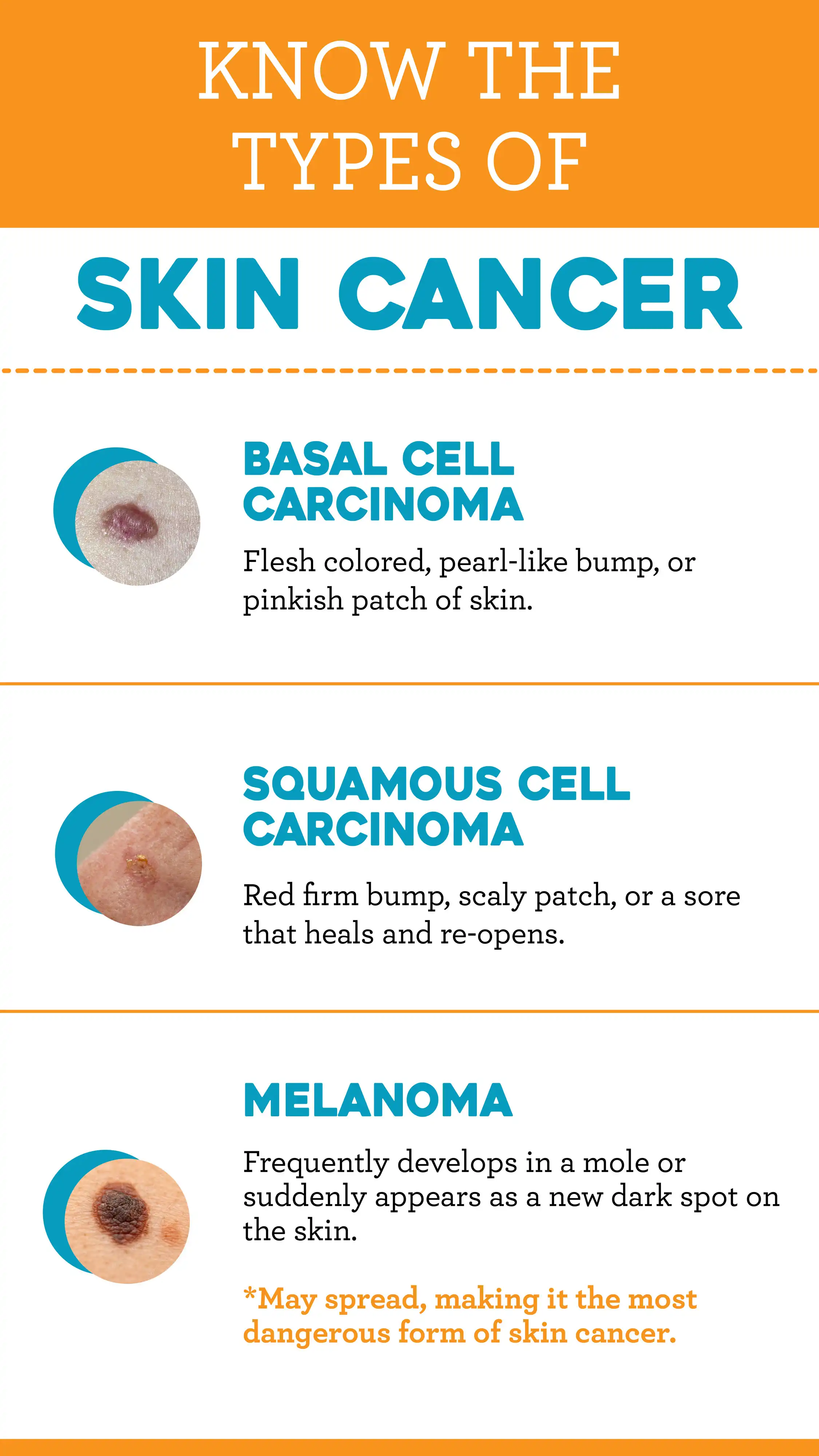 Skin Cancer Awareness  Types Of Skin Cancer