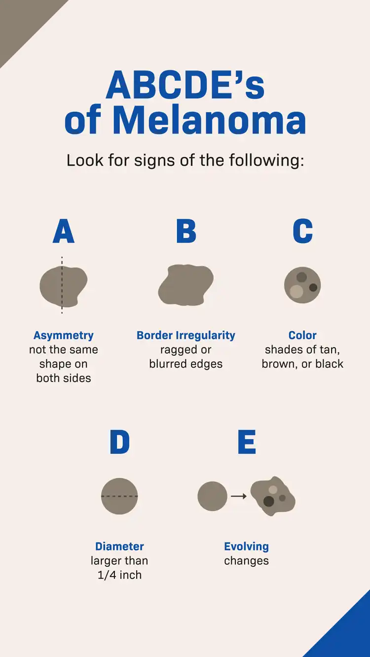 Mens Health  Melanoma ABCDE